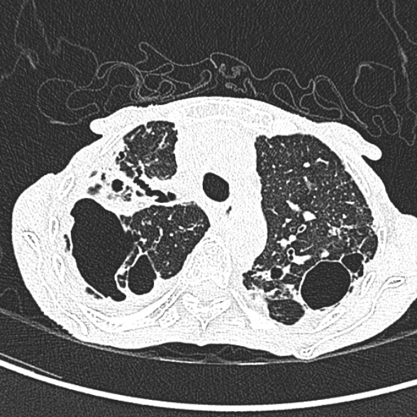 Aspergilloma- with Monod sign (Radiopaedia 44737-48532 Axial lung window 83).jpg