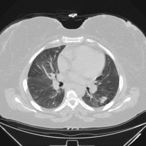 Aspergilloma (Radiopaedia 39611-41932 Axial lung window 65).jpg