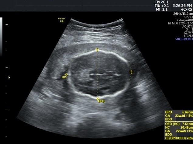 File:Asymmetrical intrauterine growth restriction with fetal distress (Radiopaedia 85176).jpg