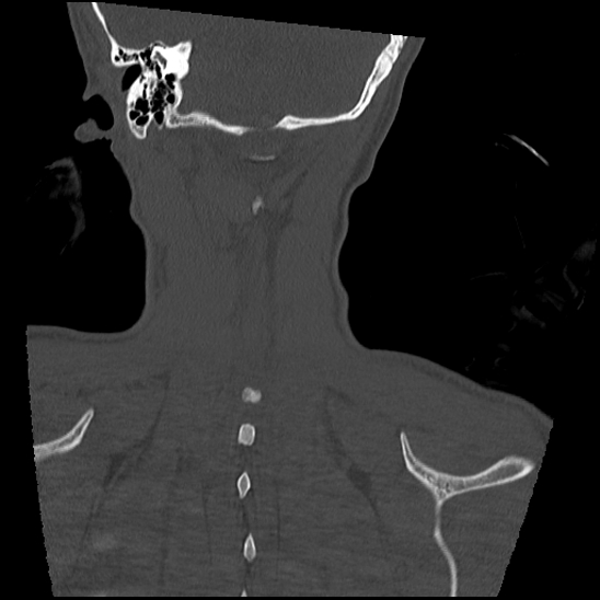 Atlanto-occipital dissociation (Traynelis type 1), C2 teardrop fracture, C6-7 facet joint dislocation (Radiopaedia 87655-104061 Coronal bone window 60).jpg