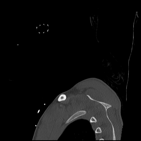 Atlanto-occipital dissociation (Traynelis type 1), C2 teardrop fracture, C6-7 facet joint dislocation (Radiopaedia 87655-104061 Sagittal bone window 81).jpg