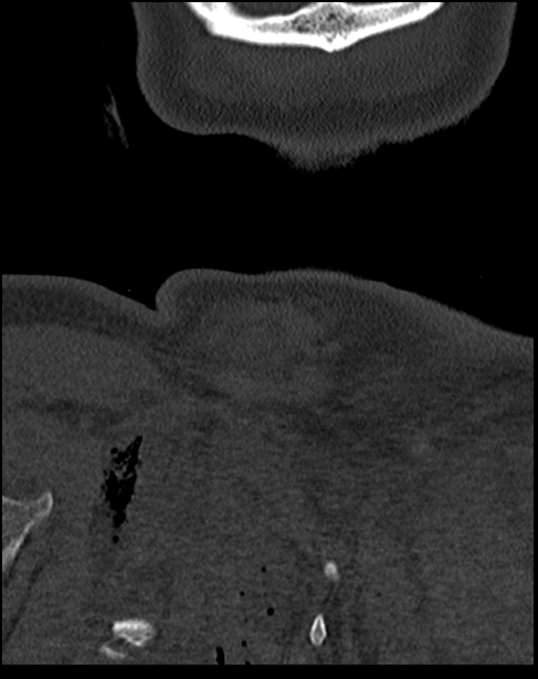 Atlanto-occipital dissociation - Traynelis type 1 (Radiopaedia 87570-103948 Coronal bone window 61).jpg