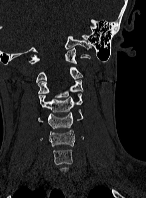 Atlantoaxial subluxation (Radiopaedia 44681-48450 Coronal bone window 61).jpg