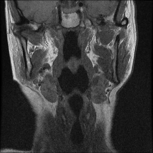 File:Atlantoaxial subluxation - rheumatoid arthritis (Radiopaedia 63564-72199 Coronal T1 1).jpg
