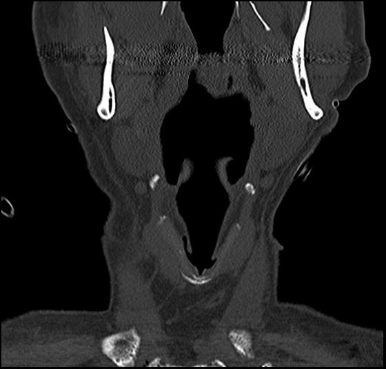 File:Atlas (type 3b subtype 1) and axis (Anderson and D'Alonzo type 3, Roy-Camille type 2) fractures (Radiopaedia 88043-104607 Coronal bone window 6).jpg