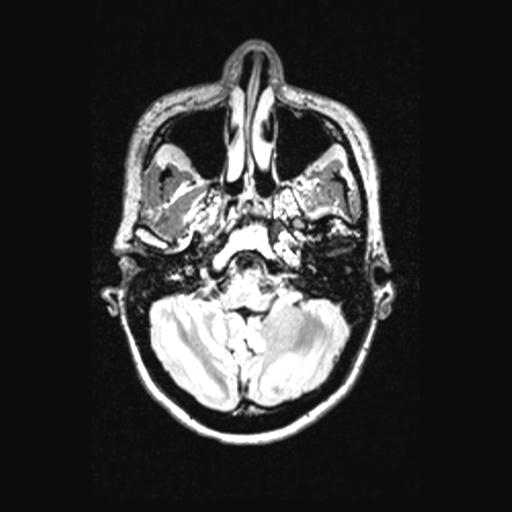 Atretic encephalocoele with inferior vermis hypoplasia (Radiopaedia 30443-31108 Axial 38).jpg