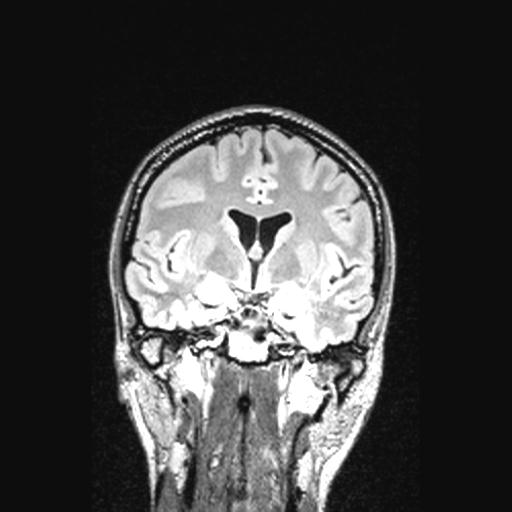 Atretic encephalocoele with inferior vermis hypoplasia (Radiopaedia 30443-31108 Coronal FLAIR 105).jpg