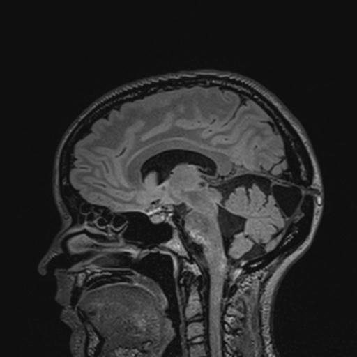 Atretic encephalocoele with inferior vermis hypoplasia (Radiopaedia 30443-31108 Sagittal FLAIR 85).jpg
