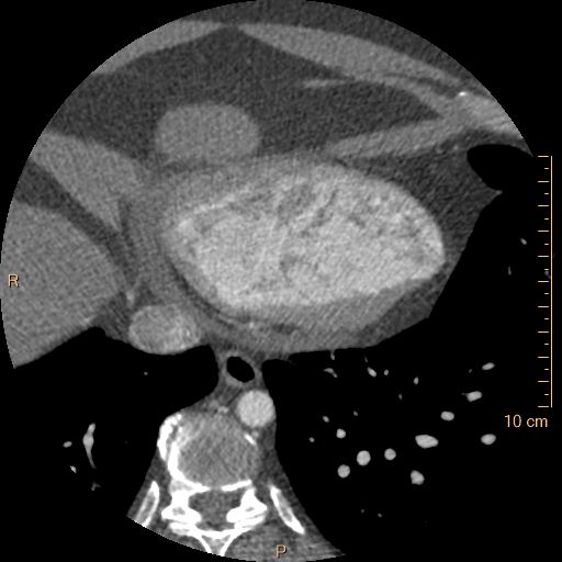 File:Atrial septal defect (upper sinus venosus type) with partial anomalous pulmonary venous return into superior vena cava (Radiopaedia 73228-83961 A 231).jpg