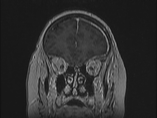 Atypical meningioma (Radiopaedia 62985-71406 Coronal T1 C+ 23).jpg