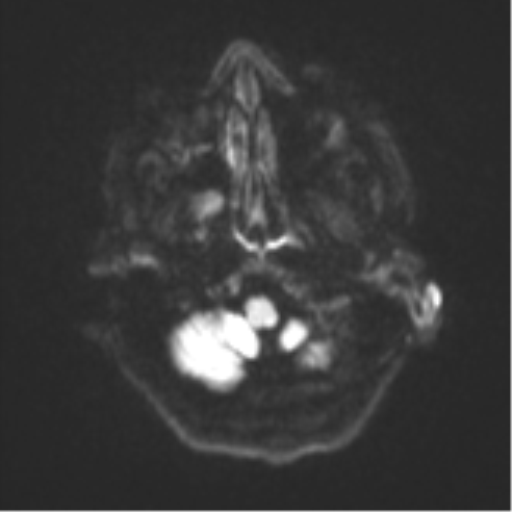 Atypical meningioma (WHO Grade II) (Radiopaedia 54742-60979 Axial DWI 32).png