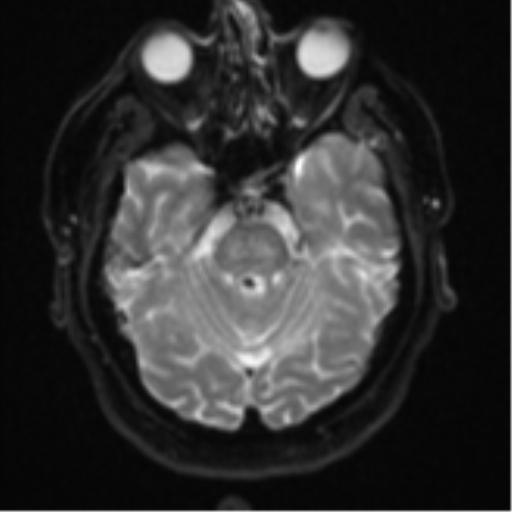 Atypical meningioma (WHO grade II) with brain invasion (Radiopaedia 57767-64729 Axial DWI 9).png