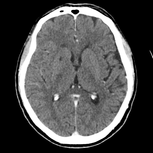 File:Atypical meningioma (WHO grade II) with osseous invasion (Radiopaedia 53654-59715 Axial C+ delayed 28).png