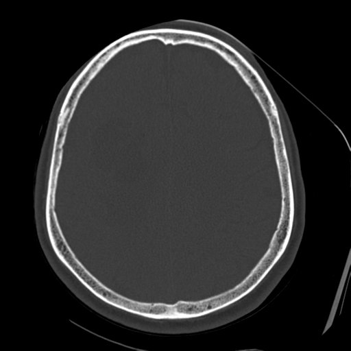 Atypical meningioma with skull invasion (Radiopaedia 34357-35649 Axial bone window 56).png