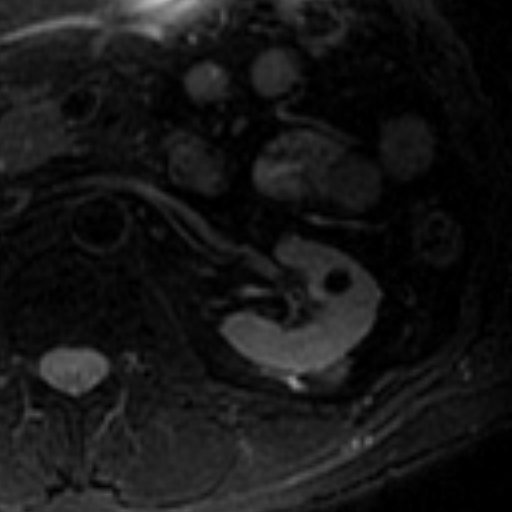 File:Atypical renal cyst on MRI (Radiopaedia 17349-17046 Axial T2 fat sat 12).jpg
