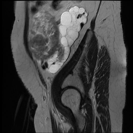 File:Atypical retroperitoneal lymphocoeles with large leiomyoma of uterus (Radiopaedia 32084-33027 Sagittal T2 3).jpg