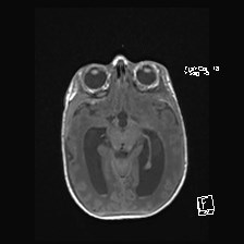 Atypical teratoid rhabdoid tumor (prenatal US and neonatal MRI) (Radiopaedia 59091-66388 Axial T1 26).jpg