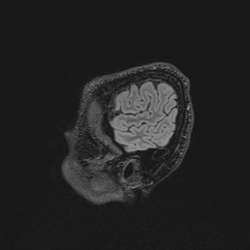 File:Autoimmune limbic encephalitis (Radiopaedia 30363-31005 Sagittal FLAIR 23).jpg