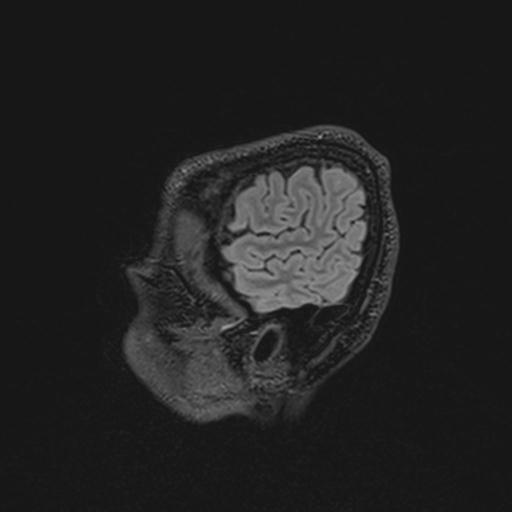 File:Autoimmune limbic encephalitis (Radiopaedia 30363-31005 Sagittal FLAIR 24).jpg