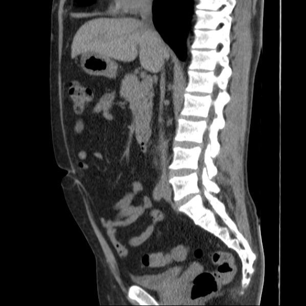 Autosomal dominant polycystic kidney disease (Radiopaedia 36539-38101 D 41).jpg