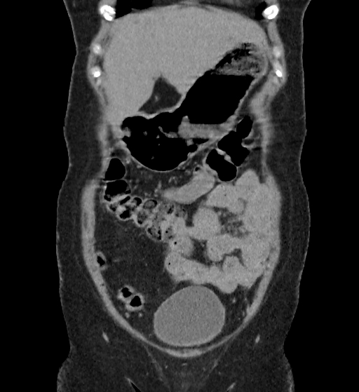 File:Autosomal dominant polycystic kidney disease (Radiopaedia 38189-40194 Coronal C+ delayed 6).jpg