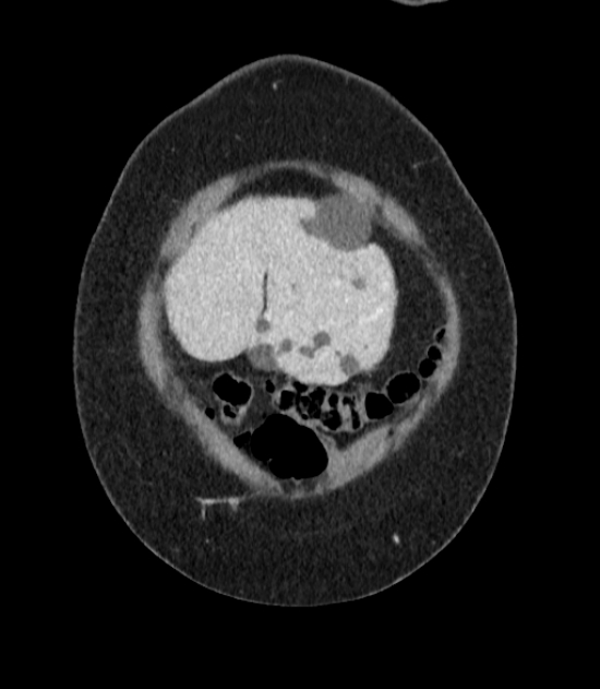 Autosomal dominant polycystic kidney disease (Radiopaedia 57124-64017 B 4).jpg