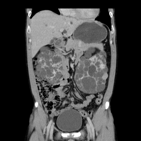 File:Autosomal dominant polycystic kidney disease (Radiopaedia 66349-75582 A 23).jpg