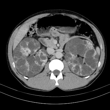 Autosomal dominant polycystic kidney disease (Radiopaedia 66349-75582 B 35).jpg