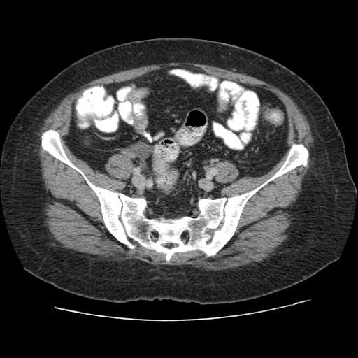 File:Autosomal dominant polycystic kidney disease with hepatic involvement (Radiopaedia 32693-33662 B 61).jpg