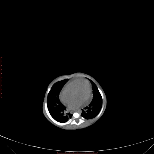 Autosomal recessive polycystic kidney disease associated with Caroli disease (Radiopaedia 61932-69984 Axial non-contrast 80).jpg