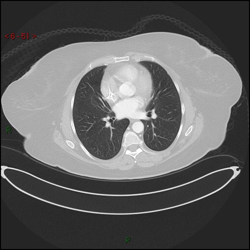 File:Azygos fissure and lobe (Radiopaedia 47620-52278 Axial lung window 51).jpg
