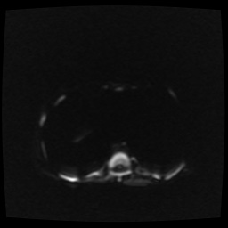 B cell lymphoma (Radiopaedia 56281-62954 Axial DWI 37).jpg