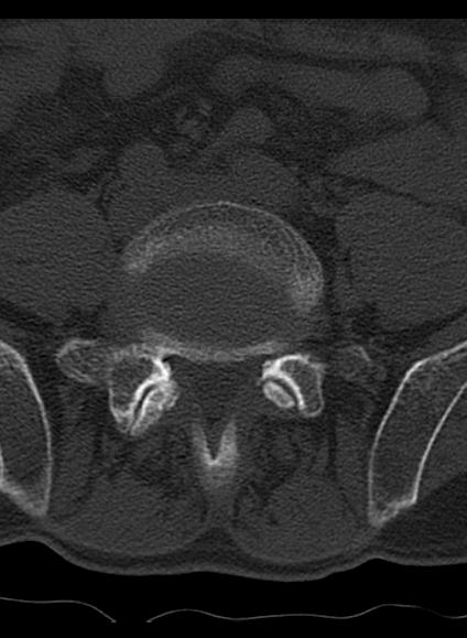 File:Baastrup syndrome (Radiopaedia 64891-73838 Axial bone window 13).jpg