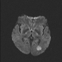 Balo concentric sclerosis (Radiopaedia 50458-55940 Axial DWI 58).jpg