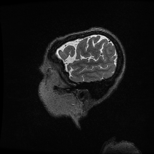 Balo concentric sclerosis (Radiopaedia 53875-59982 Sagittal 3D FSE 27).jpg