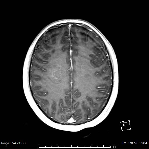 Balo concentric sclerosis (Radiopaedia 61637-69636 Axial T1 C+ 54).jpg