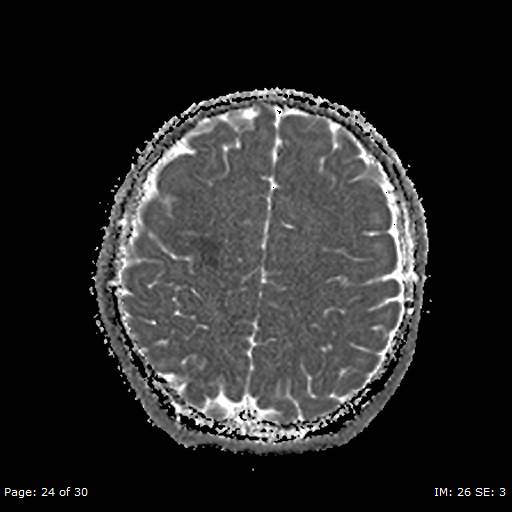 Balo concentric sclerosis (Radiopaedia 61637-69636 I 152).jpg