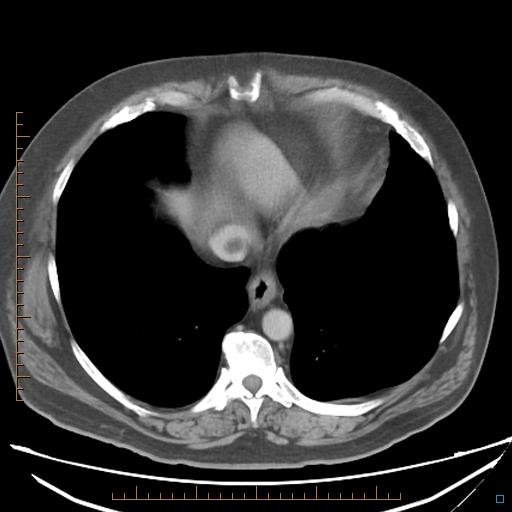 File:Bariatric balloon causing gastric outlet obstruction (Radiopaedia 54449-60672 A 5).jpg