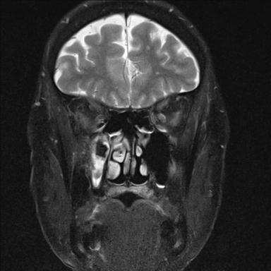 File:Base of skull chondrosarcoma (Radiopaedia 30410-31070 Coronal T2 fat sat 9).jpg