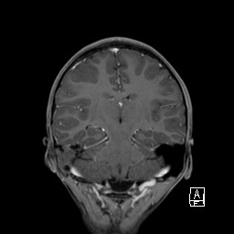Base of skull rhabdomyosarcoma (Radiopaedia 32196-33142 I 44).jpg