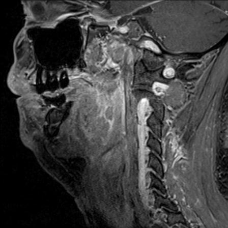 Base of tongue squamous cell carcinoma (Radiopaedia 31174-31884 F 64).jpg