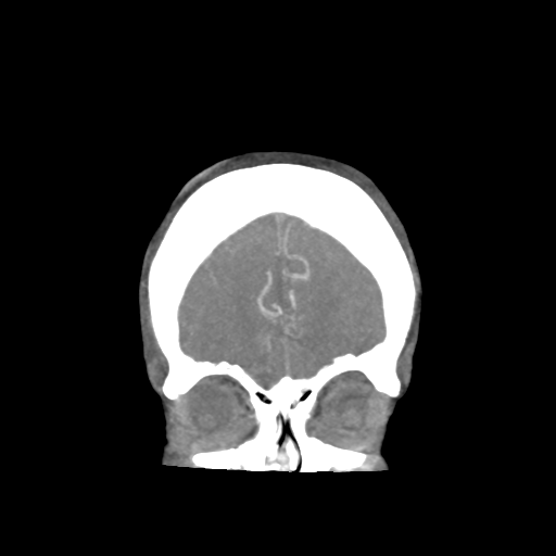 Basilar and bilateral vertebral artery occlusion (Radiopaedia 45592-49723 B 18).png