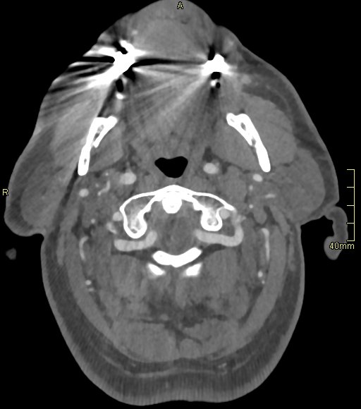 Basilar artery aneurysm (Radiopaedia 56261-62932 A 28).jpg