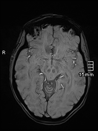 Basilar artery perforator aneurysm (Radiopaedia 82455-99523 Axial SWI 28).jpg