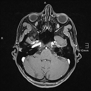 Basilar artery perforator aneurysm (Radiopaedia 82455-99523 G 25).jpg