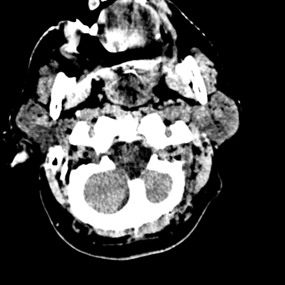 Basilar artery thrombosis (Radiopaedia 53351-59333 Axial non-contrast 16).jpg
