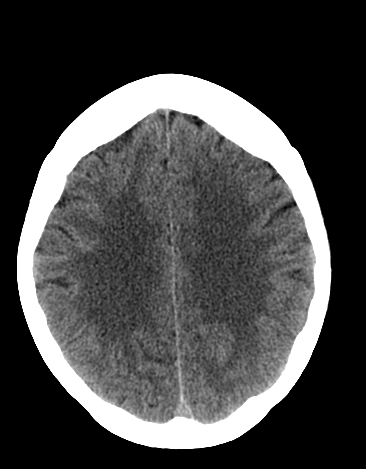File:Basilar tip aneurysm with coiling (Radiopaedia 53912-60033 Axial non-contrast 19).jpg