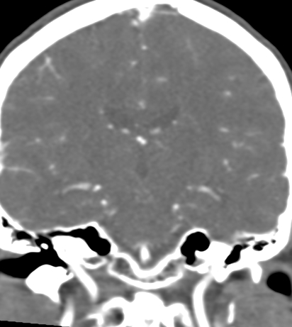 File:Basilar tip aneurysm with coiling (Radiopaedia 53912-60086 B 82).jpg