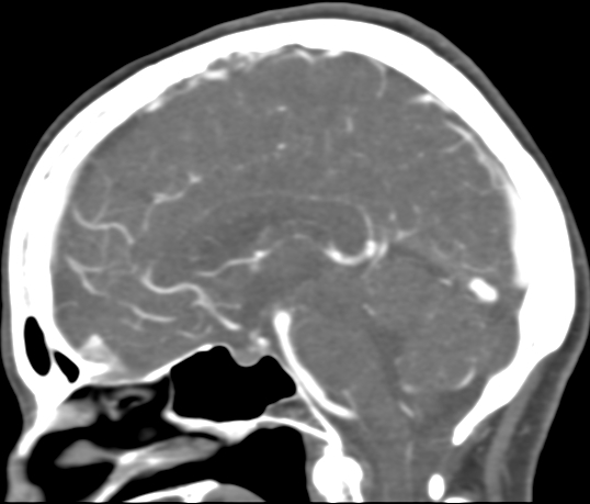 Basilar tip aneurysm with coiling (Radiopaedia 53912-60086 C 65).jpg