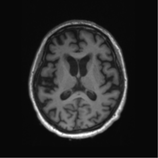 Behavioral variant frontotemporal dementia and late onset schizophrenia (Radiopaedia 52197-58083 Axial T1 44).png